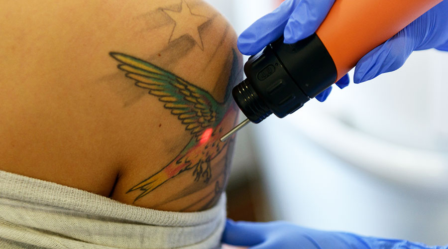 Laserentfernung von Tattoos künftig nur noch beim Arzt!